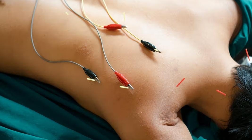 Electro-acupuncture